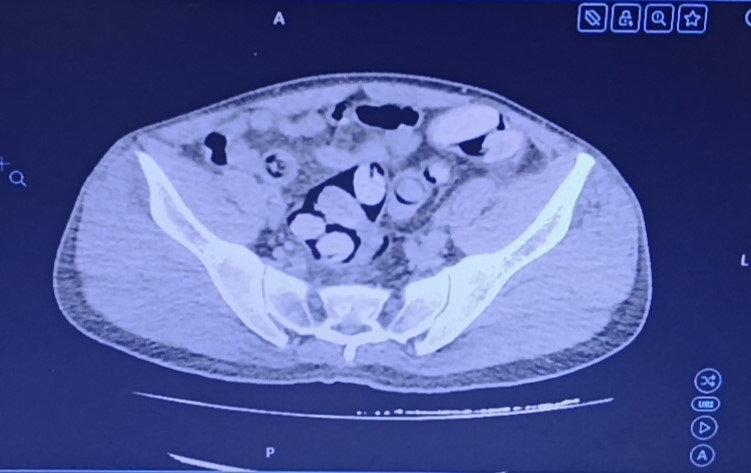 Midesinden 1 kilo uyuşturucu çıktı.