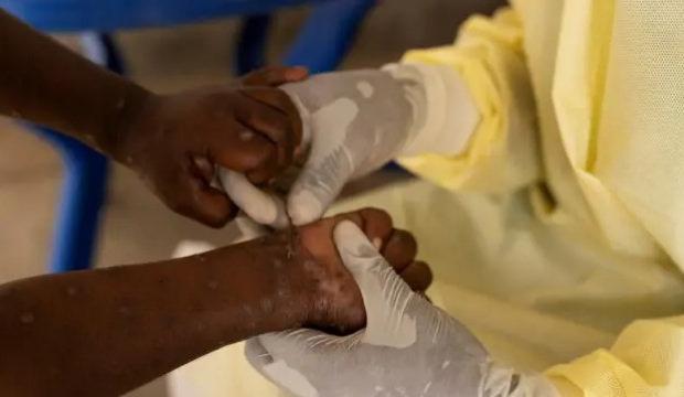 G&uuml;ney Afrika&rsquo;da son 5 haftada 13 kişide M &ccedil;i&ccedil;eği vakası kaydedildi