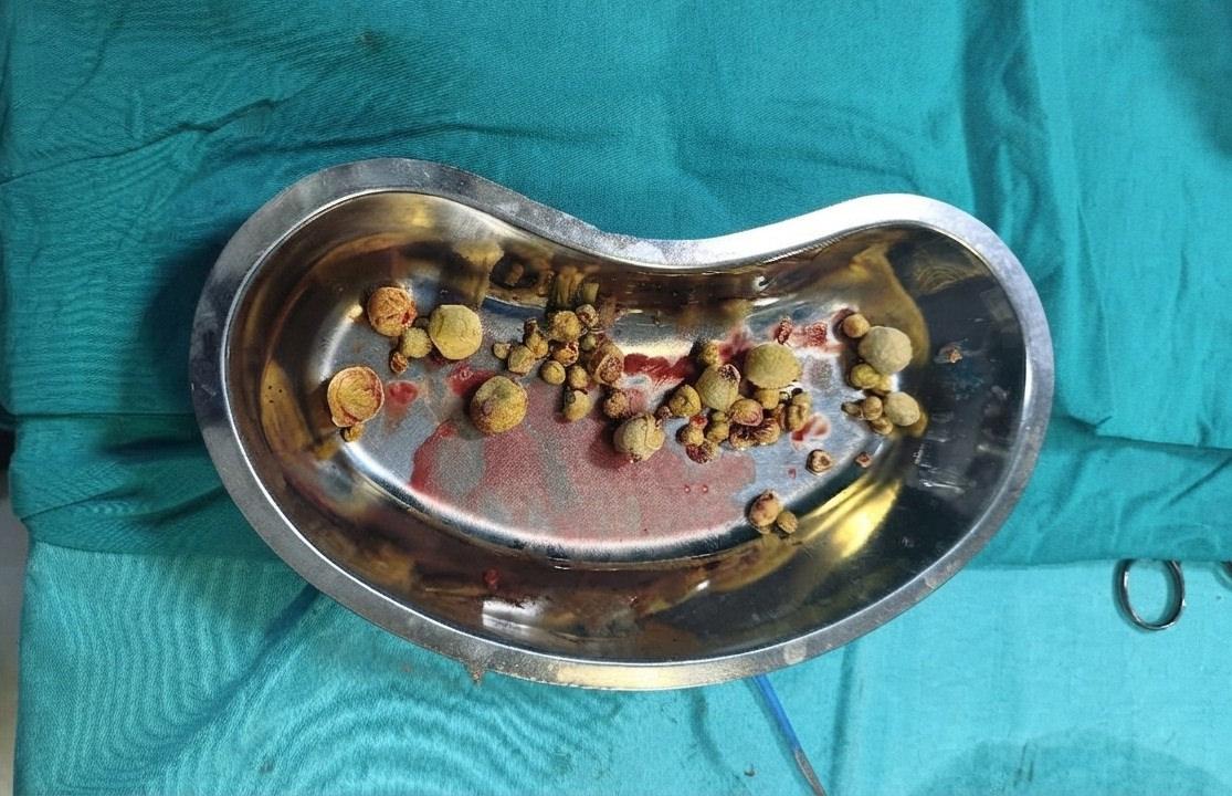 Hastanın mesanesinden çıkartılan taşlar.