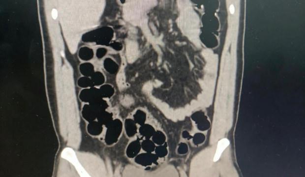 Midesinden kaps&uuml;ller i&ccedil;inde 943 gram eroin &ccedil;ıktı