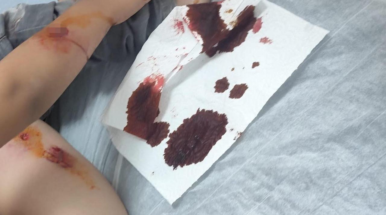 Eve dönerken köpeklerin saldırısına uğrayan öğrencinin başına 15 dikiş atıldı.