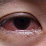 Göz alerjisi körlüğe sebep olabilir