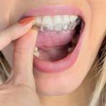 Diş sıkmanın nedenleri ve tedavisi