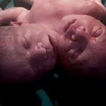 İki başlı bebek dünyaya geldi