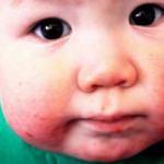 Bebeklerde ağız yaraları nasıl geçer? Bebeklerde ağız içi yara belirtileri ve evde tedavi yöntemleri