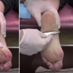 Topuk dikeni neden olur ve nasıl tedavi edilir?