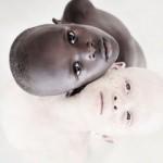 Albinizmli çocukların güzellikleri büyüledi