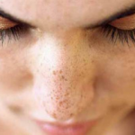 Cilt lekelerinden kurtulmanın yolları!