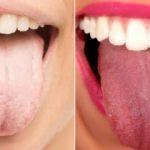 Beyaz dil sorununa doğal çözümler