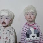 Albino kardeşler görenlerin yüreklerini burkuyor
