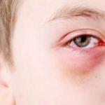 Gözlerinizi bahar alerjisinden korumanın 5 yolu