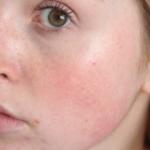 Gül hastalığı nedir? Tedavisi var mıdır?