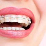 Diş teli neden takılır? Diş teli çeşitleri nelerdir?