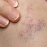 Trombosit (PLT) düşüklüğü nedir? Trombosit düşüklüğü belirtileri nelerdir?