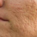 Yüzdeki sivilce izleri nasıl gider? Sivilce izlerini gideren maske tarifleri