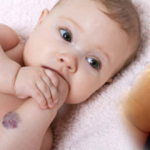 Bebeklerde doğum lekesi neden olur, kalıcı mı? Doğum lekesi çeşitleri neler? Saraçoğlu'ndan kür