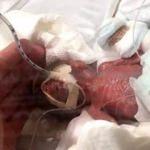 D&uuml;nyanın en k&uuml;&ccedil;&uuml;k bebeği doğdu