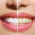 Doğal, etkili ve kalıcı diş beyazlatma yöntemleri! Bembeyaz dişler...