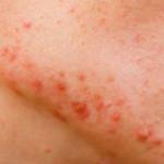 Kistik akneler nasıl geçer? Kistik sivilceye ne iyi gelir?