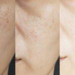 Yüzde oluşan delik ve çukurlar nasıl geçer? Yüzde delik neden olur?