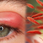 &Ccedil;ıban neden &ccedil;ıkar ve belirtileri nelerdir? &Ccedil;ıban tedavisinde doğal y&ouml;ntemler...