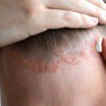 Seboreik dermatit belirtileri neler ve kimlerde görülür? Hastalığı tetikleyen besinler