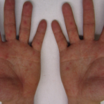 Zona hastalığı (Gece yanığı) nedir? Zona hastalığının belirtileri nelerdir?