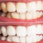 Diş sararması nasıl geçer? 7 günde dişleri bembeyaz yapan karışım