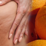 Selülit nedir,nasıl geçer? Selülite neden olan besinler nelerdir? Nescafe selülit yapar mı?