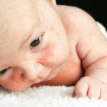 Bebeklerde isilik nasıl geçer? İsilik olan bebeklerde doğal çözümler ve isilik nedenleri