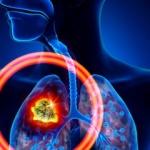 Akciğer kanserinin belirtileri nelerdir? Akciğer kanseri tedavisi var mıdır? Akciğer kanserini önlemek için...