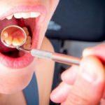 Damak yarası neden olur? Damak yarası belirtileri nelerdir? Damak yarasına ne iyi gelir?