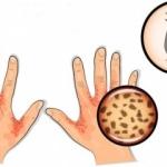 Uyuz nedir? Uyuz hastalığı nasıl anlaşılır? Uyuz belirtileri nelerdir? Uyuz nasıl tedavi edilir