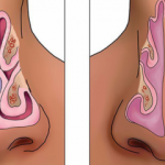Burun kemiği eğriliği (Deviasyon) neden olur? Burun kemiği eğriliğinin belirtileri nelerdir?