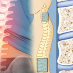 Omurilik daralması nedir? Omurilik daralması belirtileri nelerdir? Omurilik daralmasının tedavisi var mıdır?