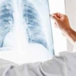 Zatürre nedir? Zatürrenin belirtileri ve tedavi yöntemleri nelerdir?