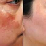 En etkili ve en iyi leke giderici eczanedeki kremler 2020