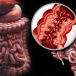 Crohn hastalığı nedir? Crohn hastalığının belirtileri nelerdir? Crohnun tedavisi var mıdır?