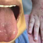 Koronavirüs ile bağlantılı şüphesi! İngiltere'de çocuklar arasında 3 haftada yayıldı