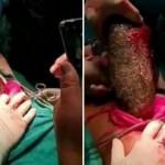 17 yaşındaki kızın karnından 7 kilo saç topu çıkartıldı