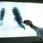 İlk kez yeni yöntemle fark edildi: Kovid-19 hastalarında 3 ay sonra ortaya çıkıyor