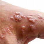 Vücuttaki kabarcıklara dikkat! Zona hastalığının habercisi olabilir