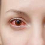 Gözün içerisindeki zarda ortaya çıkıyor! Pterjium hastalığı belirtileri nelerdir?