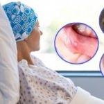 Ağızda, dilde ve dudaklarda geçmeyen yaralara dikkat! Ciddi hastalıkların habercisi olabilir