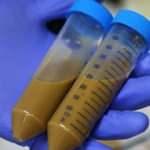 Dışkı nakli ile ölümcül cilt kanserine çözüm umudu: Yaşam süresini iki kat uzattı