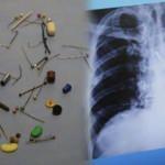 Hepsi insan vücudundan çıkarıldı: 13 santimlik çividen tespih tanesine kadar 80 ilginç cisim!