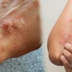 Bahar aylarında ortaya çıkıyor! Kurdeşene dikkat