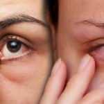 Gözlerde yanma, batma ve kızarıklığa dikkat!