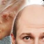 Koronavirüste kurdeşen haberci, saç dökülmesi belirti!