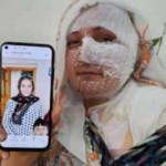 Eşinin kızgın yağ ile yaktığı kadın: Ölmek istemiyorum